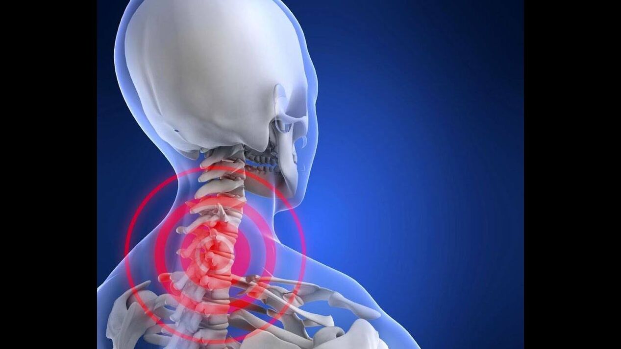 Mugurkaula kakla mugurkaula osteohondroze
