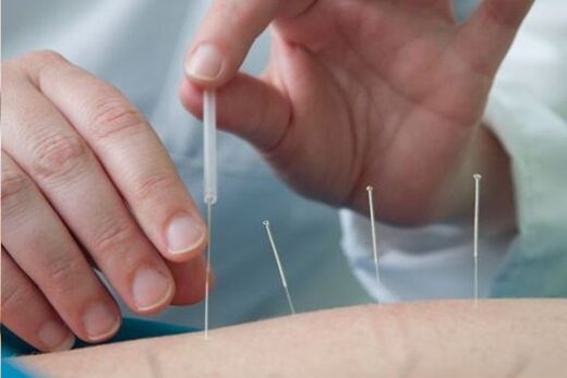 Akupunktūra - osteohondrozes izraisītu sāpju ārstēšanas metode jostas rajonā
