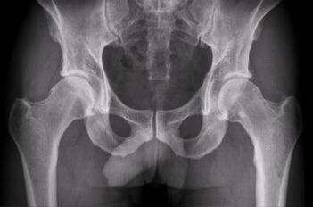 Diagnostikas iespējas gūžas locītavas artrozei