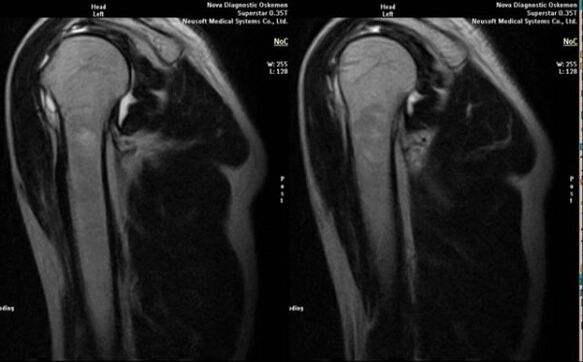 rentgens, lai diagnosticētu pleca locītavas artrozi
