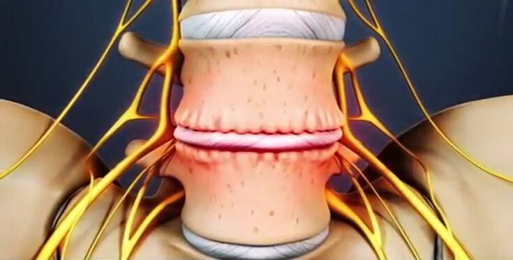 mugurkaula bojājumi osteohondrozes dēļ